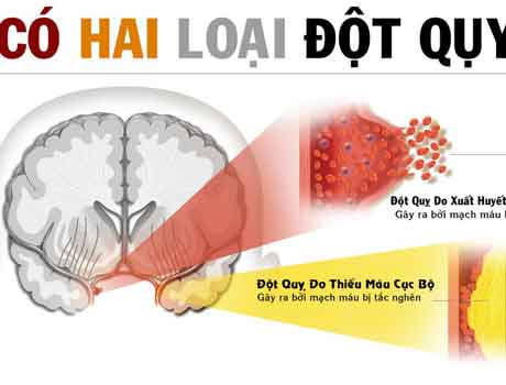 Phòng tránh tai biến mạch máu não ở bệnh nhân cao huyết áp!
